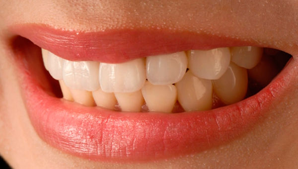 ¿Qué son las carillas dentales y en qué pacientes están indicadas?