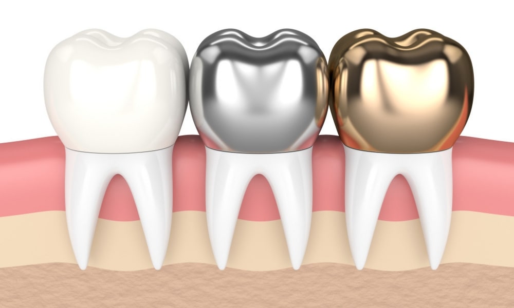 ¿Qué son las coronas Dentales?
